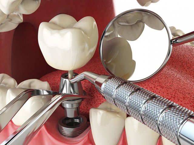 Information For Mini Dental Implant Patients